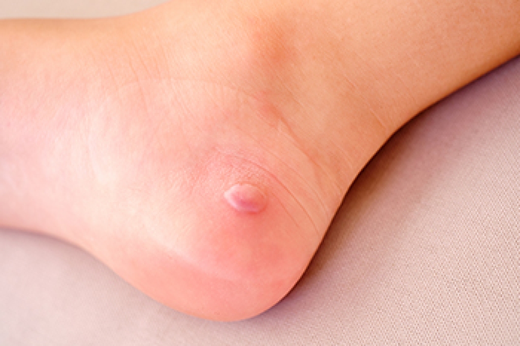 Foot Blisters and Podiatric Care