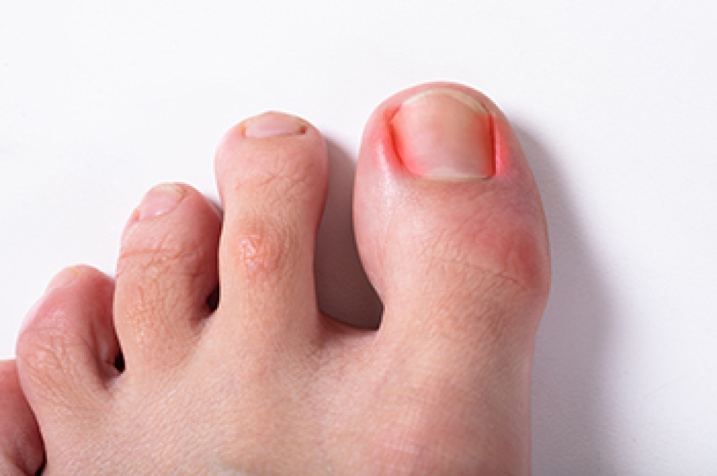 Causes and Risk Factors for Ingrown Toenails