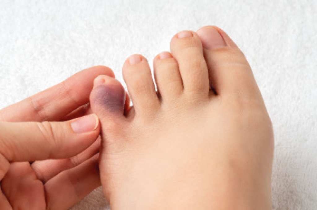 How a Podiatrist Diagnoses and Treats Broken Toes