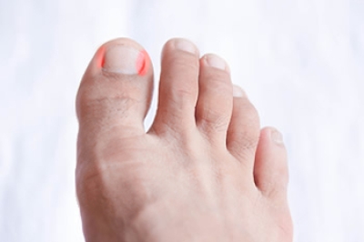 Relieving Pain From an Ingrown Toenail