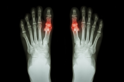 Have Painful Gout?