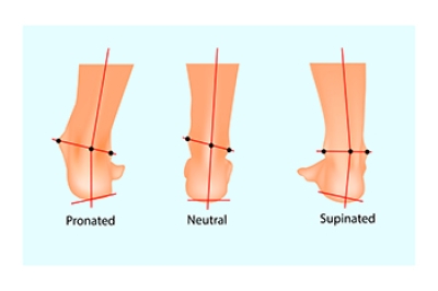 How Overpronation Can Affect the Feet