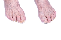 Foot Problems in Older Adults and Their Impact on Mobility