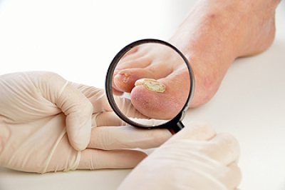 Common Fungal Infections That Affect the Feet