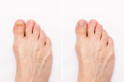 Facts About Toenail Fungus