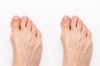 Facts About Toenail Fungus