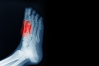 Sesamoiditis and Managing Pain Beneath the Big Toe